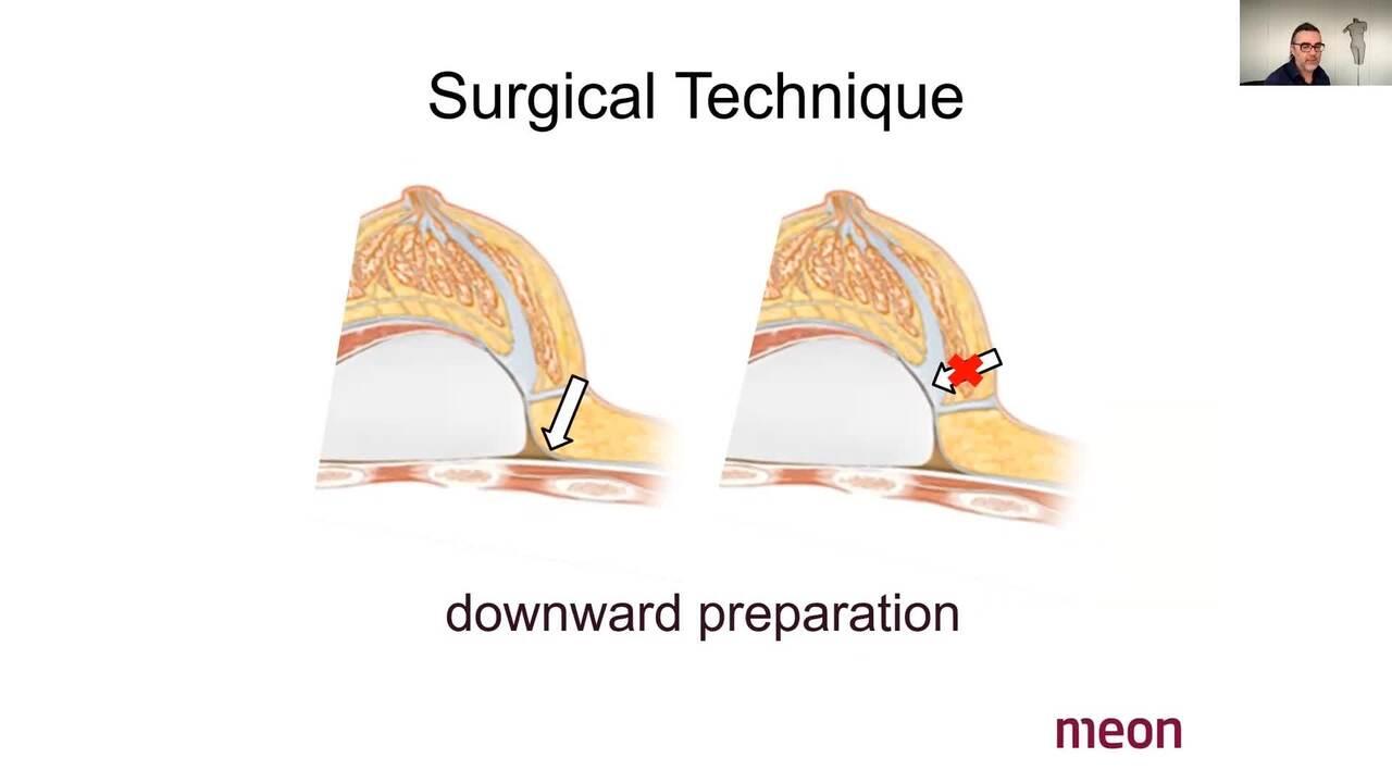 An Image From "What are the advantages of the sub-glandular plane for Breast Augmentation? Bosch"