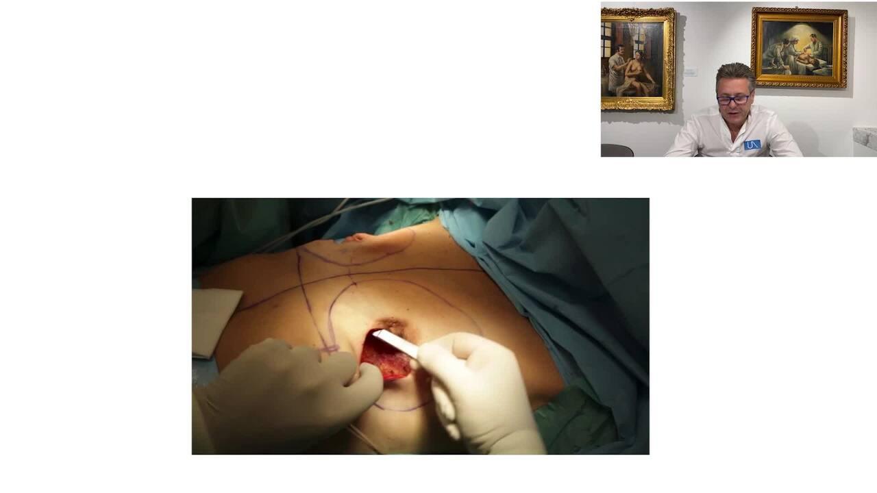 An Image From "Fundamentals of Implant Based Breast Reconstruction"