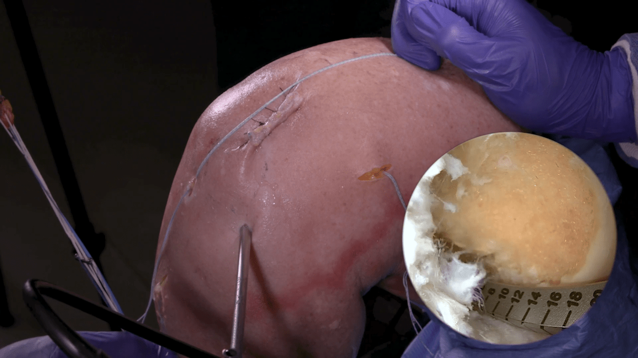 All-Inside ACLR using Quad Tendon: Graft Placement with Justin Ernat, MD thumbnail image