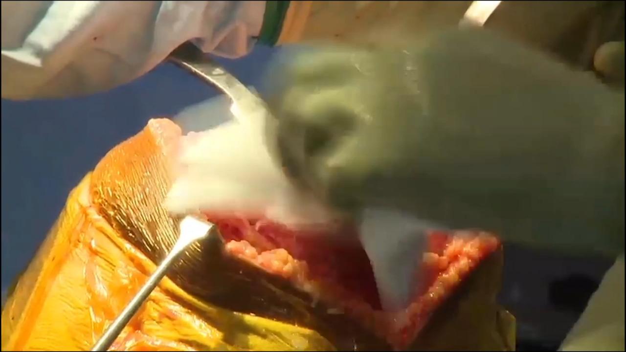 ATTUNE® Knee Cruciate Sacrificing, Rotating Platform, Balanced Resection Surgery: Cementing the Implants with Peter James, MD thumbnail image