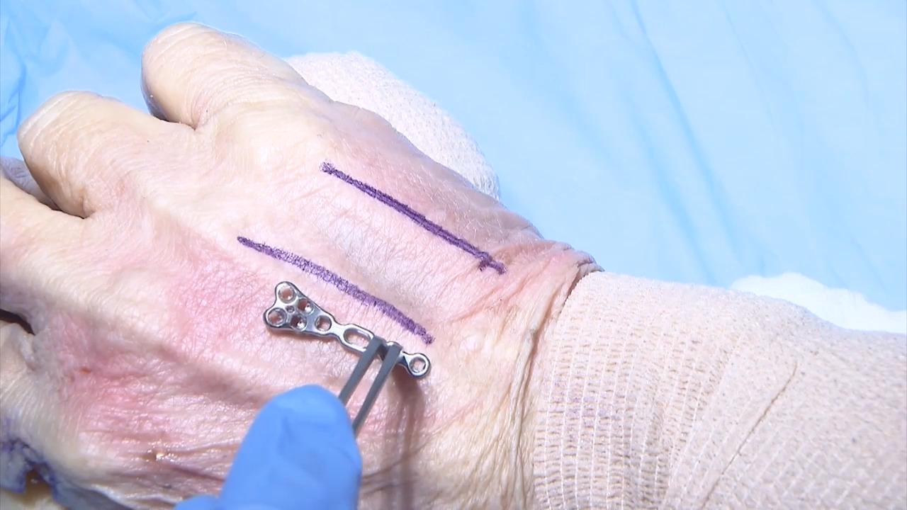 VA Locking Hand System: Metcarpal Neck Plate with Marc Richards, MD thumbnail image