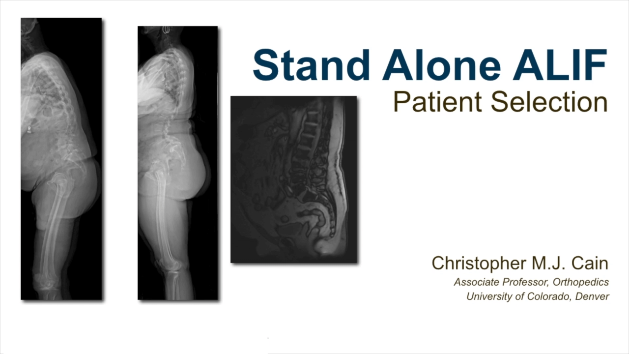 Stand Alone ALIF - Patient Selection with Christopher Cain, MD thumbnail image