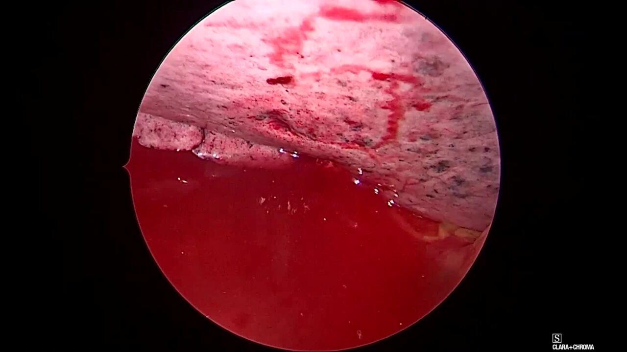 Thorascopic Lobectomy - Air Leak Test