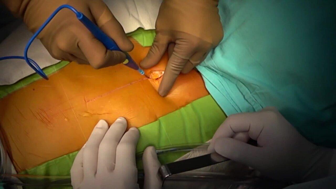 Aortic Valve Replacement (AVR) - Sternotomy