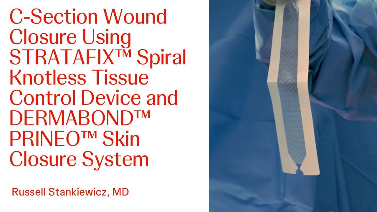 An image of the "C-Section Wound Closure using STRATAFIX and Dermabond PRINEO 22 with Russell Stankiewicz, MD" video on the JnJInstitute.com website.