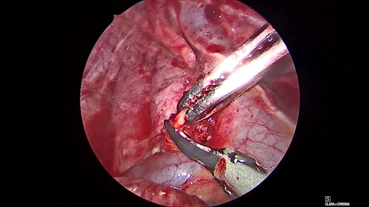 Thorascopic Lobectomy - Complete the Lymphadenectomy