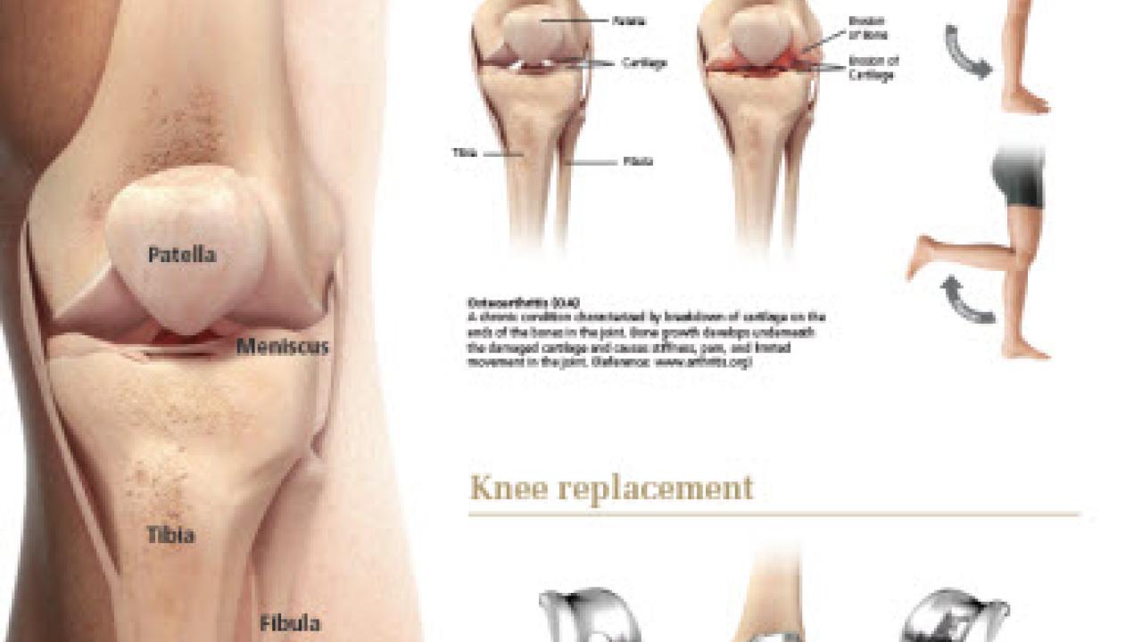 An image of the "Knee Replacement Anatomical Poster" pdf on the JnJInstitute.com website.