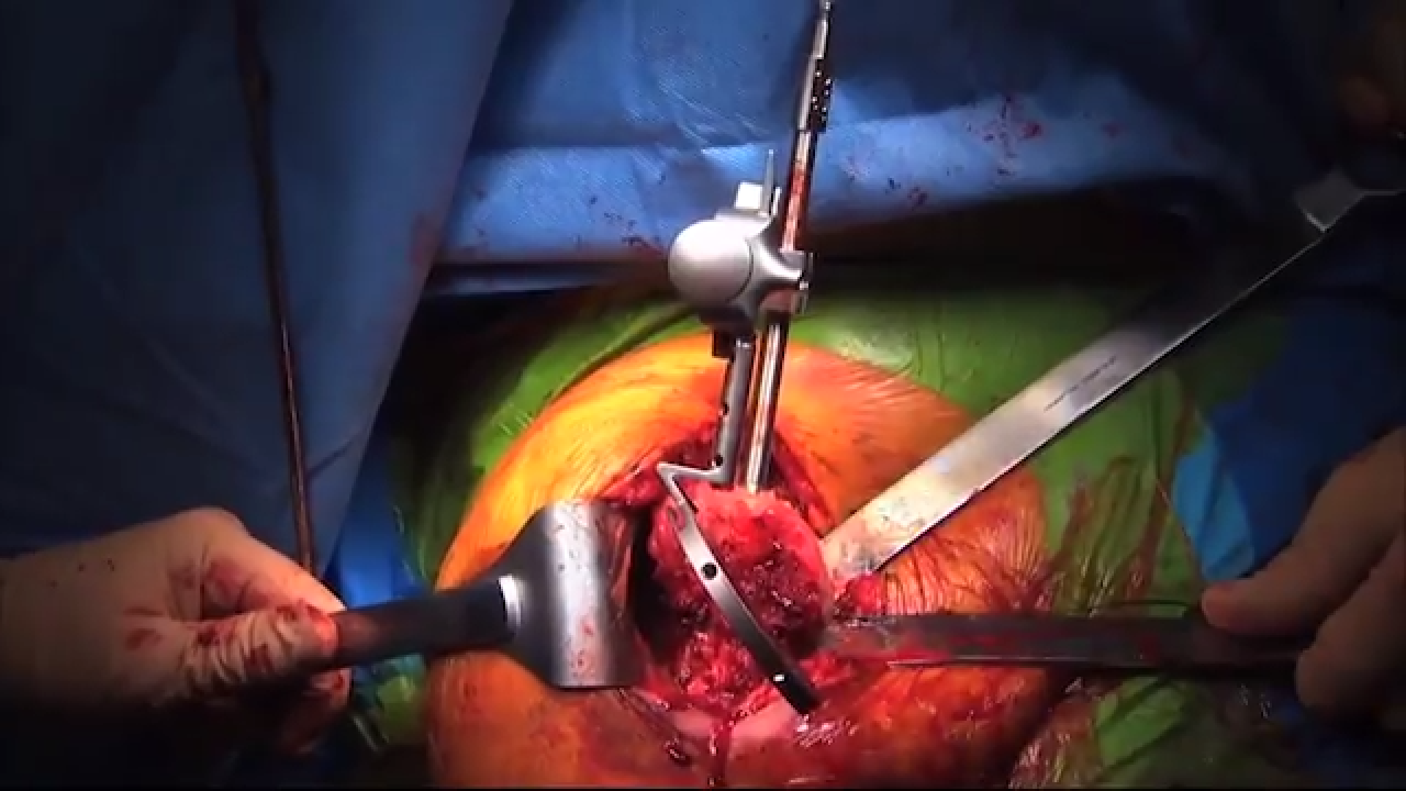 Image of the GLOBAL UNITE® Anatomic Shoulder Surgical Video with Paul Favorito, MD