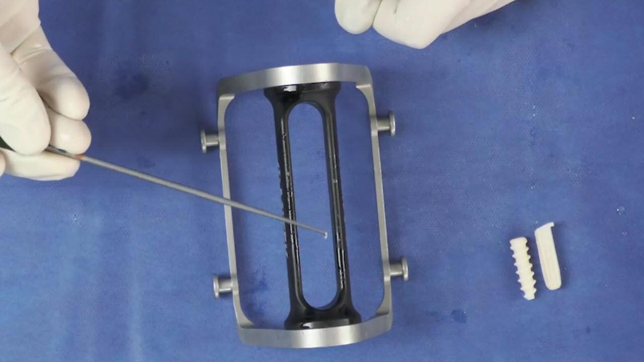 ACL Reconstruction: Tibial Fixation with INTRAFIX™: Amir Moinfar, MD