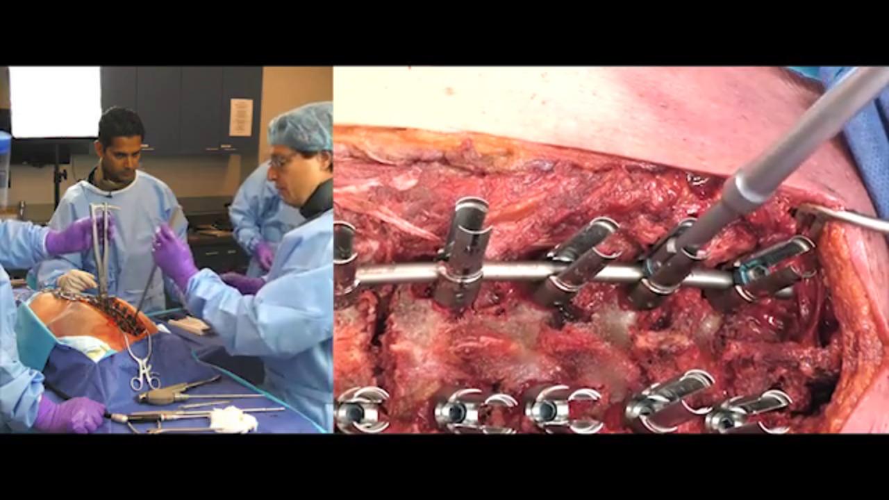 An image of the "EXPEDIUM VERSE® System - 3 Dimensional Deformity Correction with Randal Betz, MD, Baron Lonner, MD, and Suken Shah, MD" video on the JnJInstitute.com website.