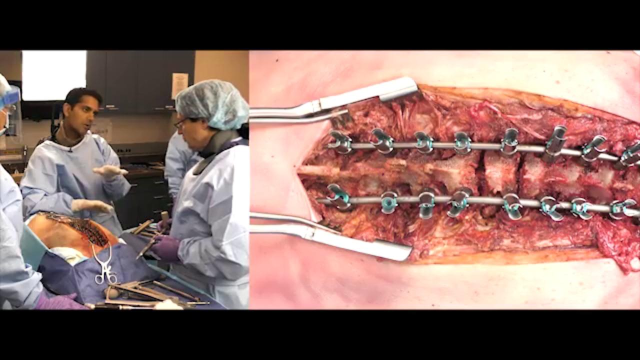 An image from the "EXPEDIUM VERSE® System - Fine Tuning with Randal Betz, MD, Baron Lonner, MD, and Suken Shah, MD" video on the JnJInstitute.com website.