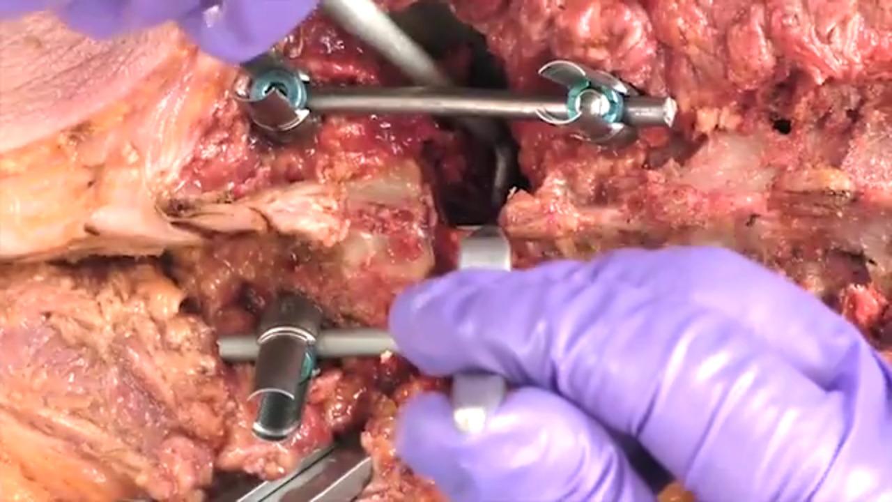 An image from the "EXPEDIUM VERSE® System - Pedicle Subtraction Osteotomy Closure with Randal Betz, MD, Baron Lonner, MD, and Suken Shah, MD" video on the JnJInstitute.com website.
