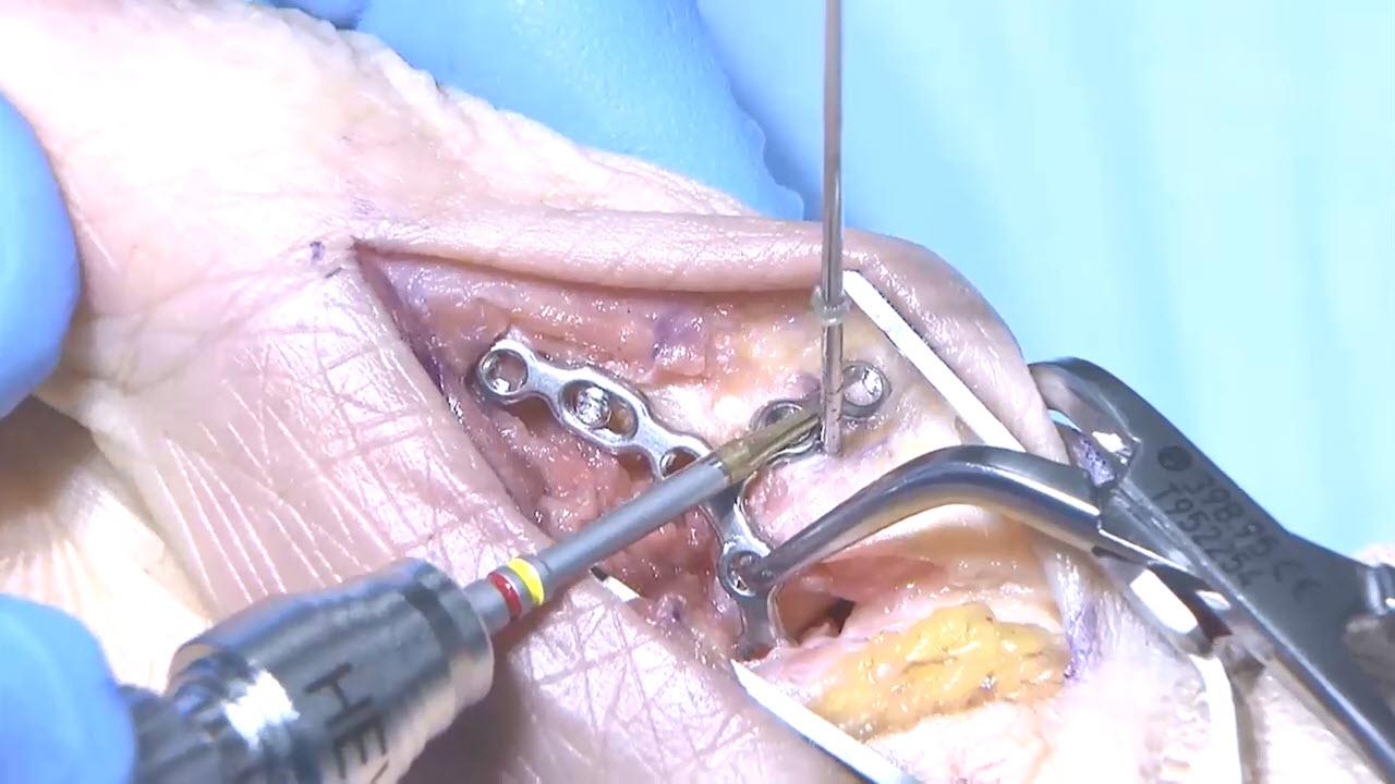 An image of the "VA Locking Hand System - First Metacarpal Plate, Lateral Approach with Thomas Fischer, MD" video.
