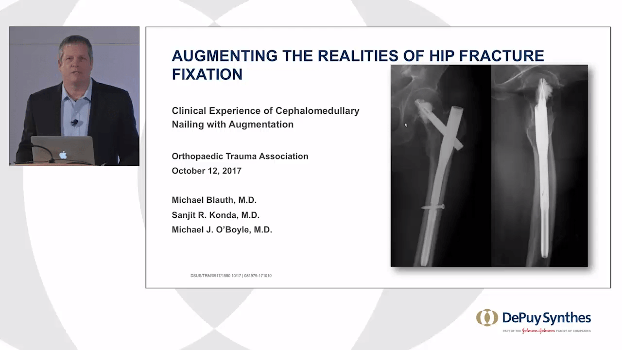 An image from the "Augmenting the Realities of Hip Fracture Fixation" video on the JnJInstitute.com website.