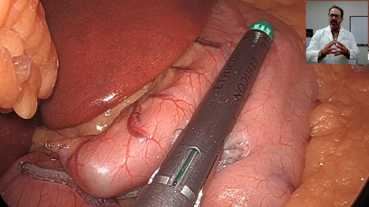 An Image From "One Anastomosis Gastric Bypass Using ECHELON™ and VISTASEAL™ Fibrin Sealant with James Dasher, MD"