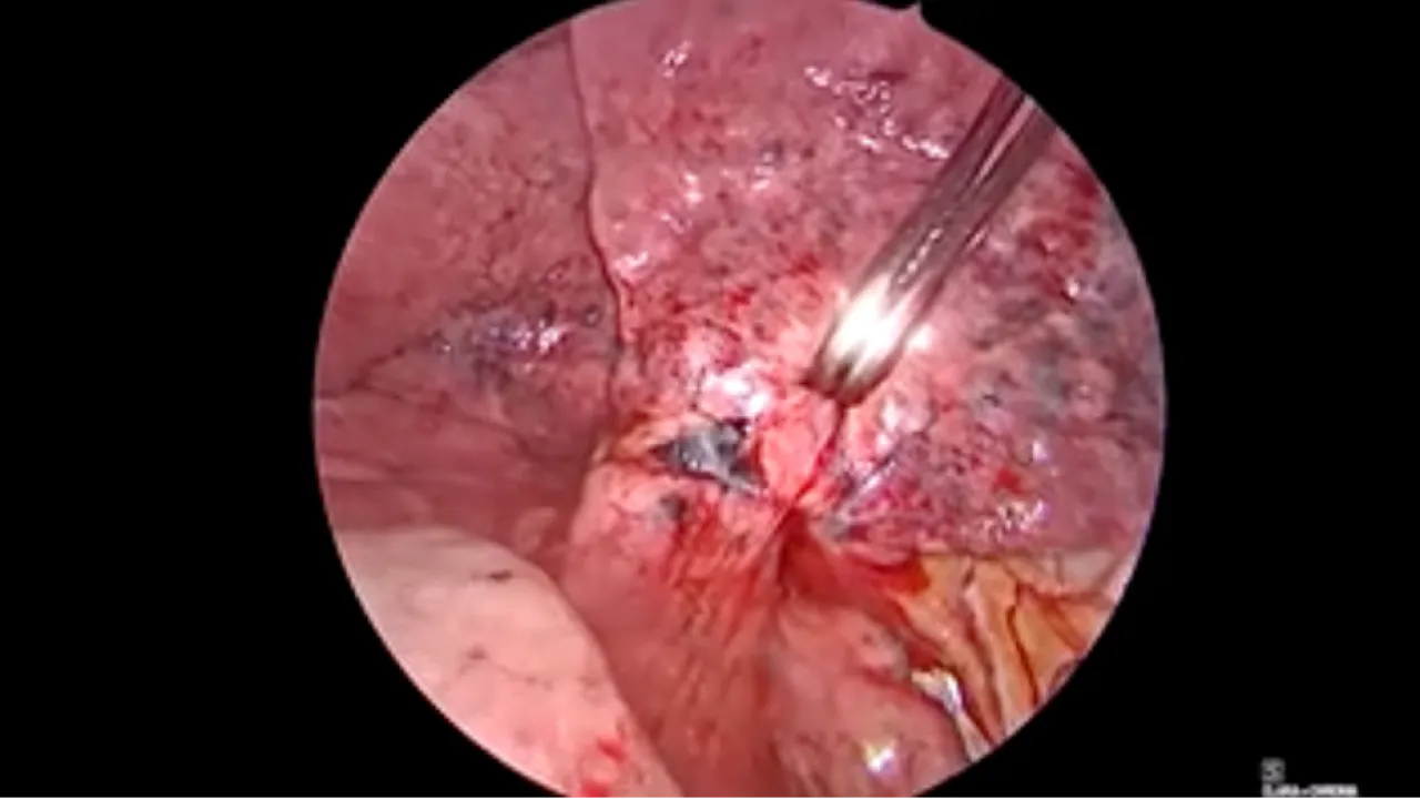 Thorascopic Lobectomy - Dissect Out & Encircle Pulmonary Artery