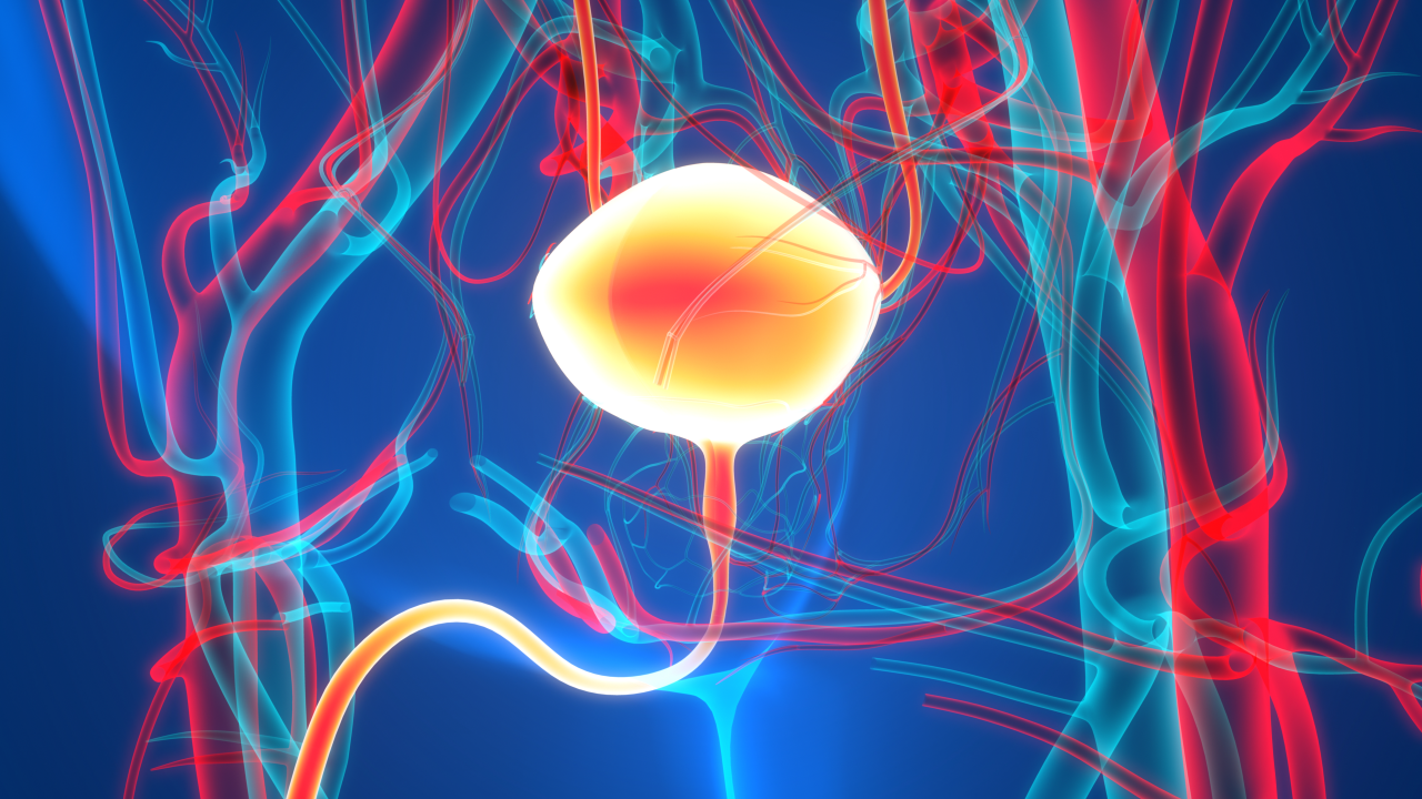 Bacillus Calmette—Guérin- Unresponsive Non—Muscle Invasive Bladder Cancer with Carcinoma In Situ (BCG-UR NMIBC CIS)