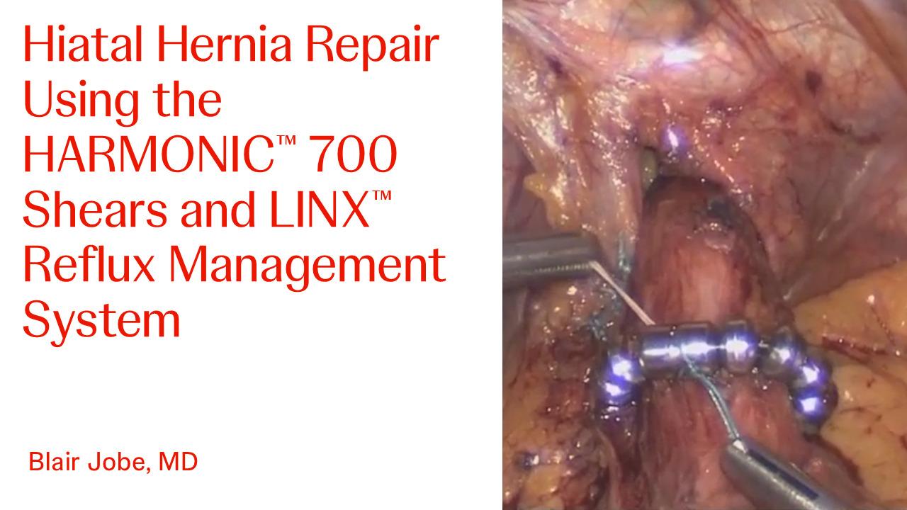 Step-by-Step Demonstration of a Hiatal Hernia Repair with Blair Jobe, MD