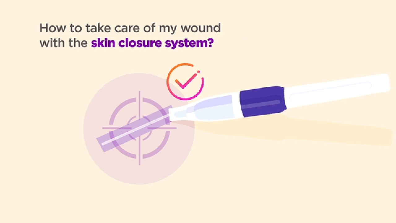 How to care for your wound with the skin closure system thumbnail