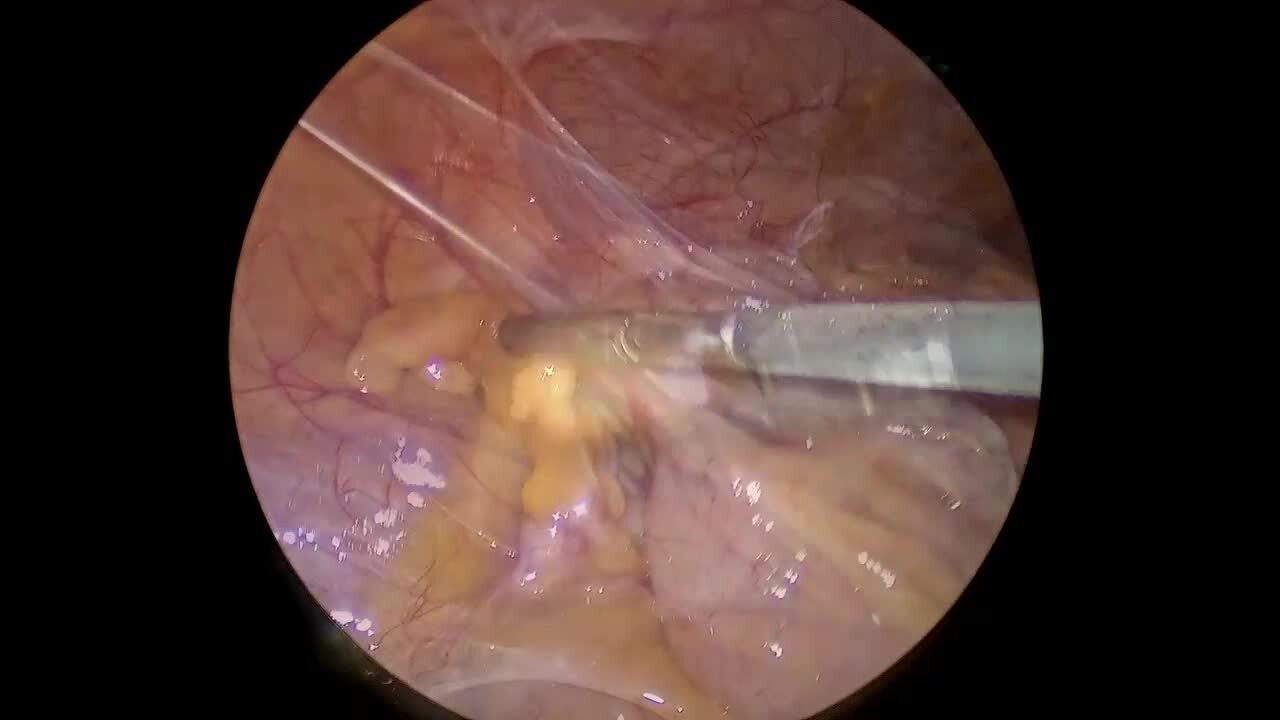 Laparoscopic Appendectomy - Retract Appendix