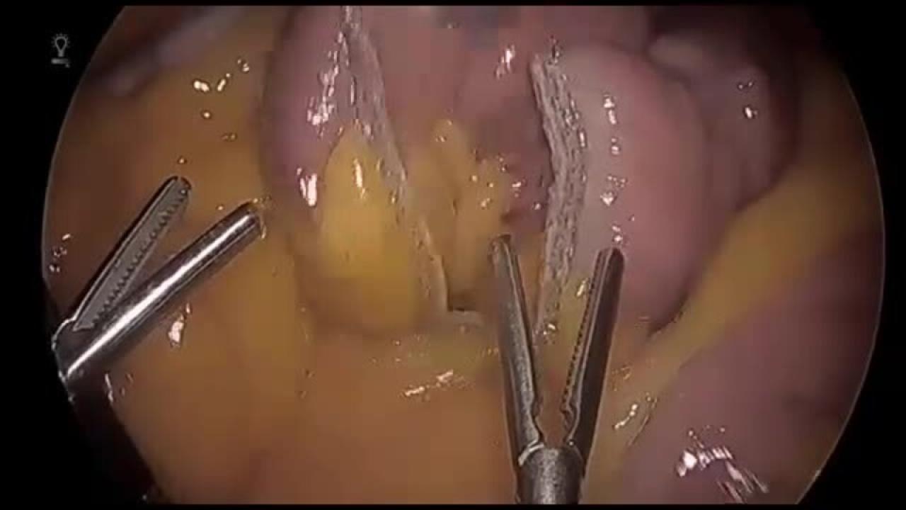 Laparoscopic Roux-en-Y Gastric Bypass - Identify the Correct Limb