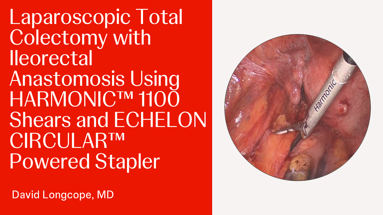 Laparoscopic Total Colectomy with Ileorectal Anastomosis Using HARMONIC™ 1100 Shears and ECHELON CIRCULAR™ Powered Stapler