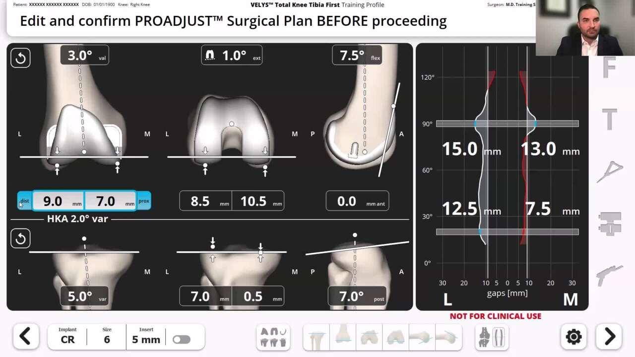 VELYS Robotic-Assisted Solution Case Walkthrough with Dr. John Redmond thumbnail