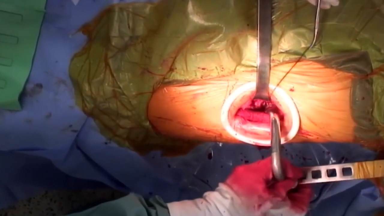 Image from Anterior Advantage Total Hip Arthroplsty: Femoral Preparation - Joel Matta, MD