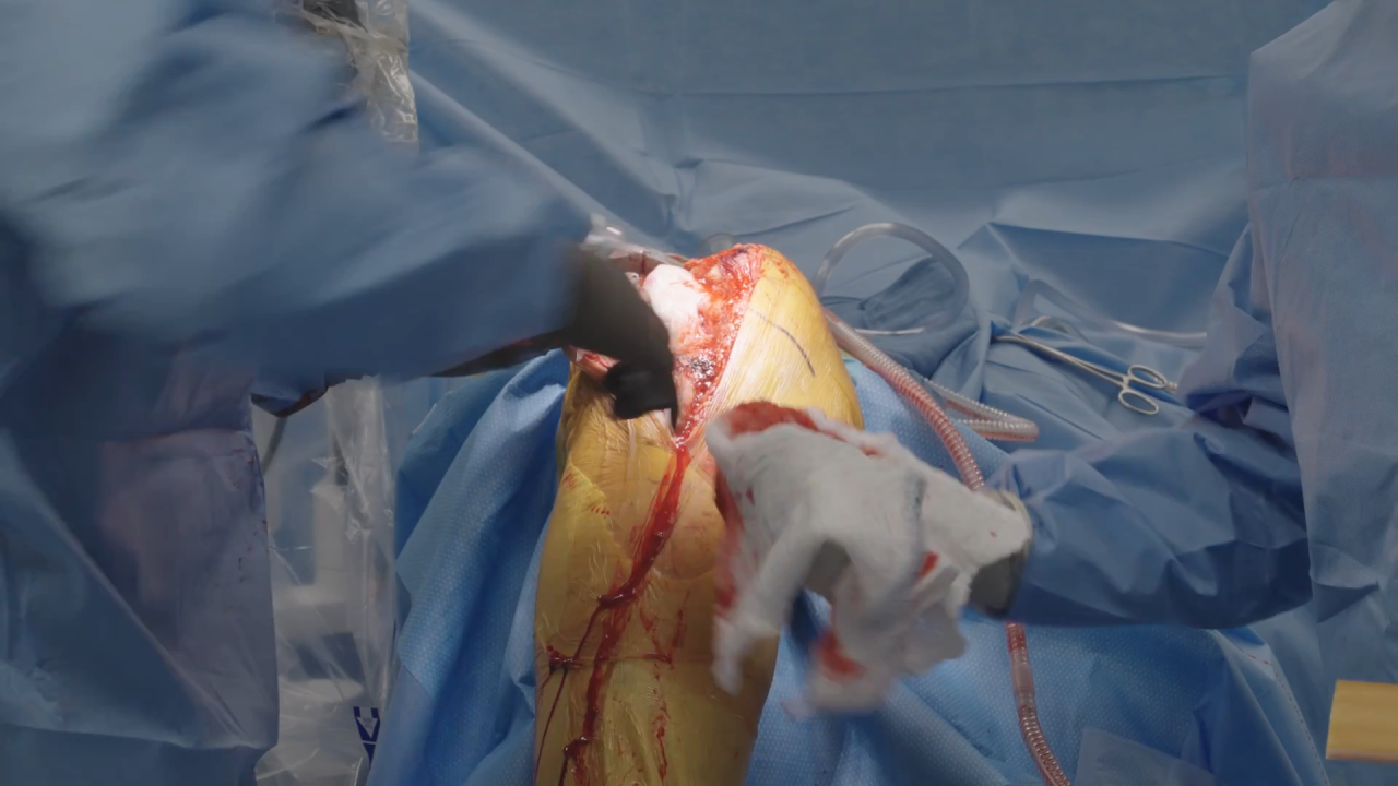 Image from Primary Total Knee using the VELYS Robotic-Assisted Solution Live Surgical Procedure - Timothy B. Alton, MD