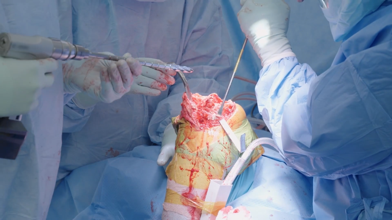 Image from ATTUNE™ Revision Knee System: Live Surgical Procedure - Wayne Moschetti, MD