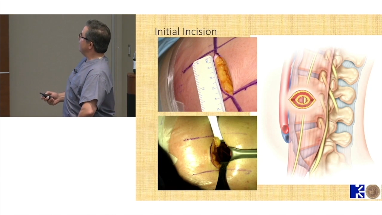Image from Left Lateral Retroperitoneal Approach: Initial Incision and Implant Placement - Andrew Sama, MD