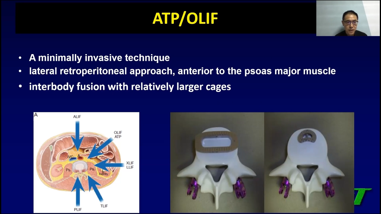 An Image From "Anterior to Psoas Approach: Treatment for Complex Lumbar Spinal Stenosis - Yuqing Sun, MD"