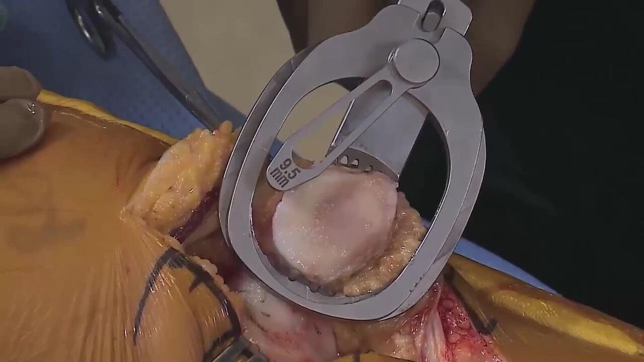 Manual Total Knee Arthroplasty with Robert Gorab, MD