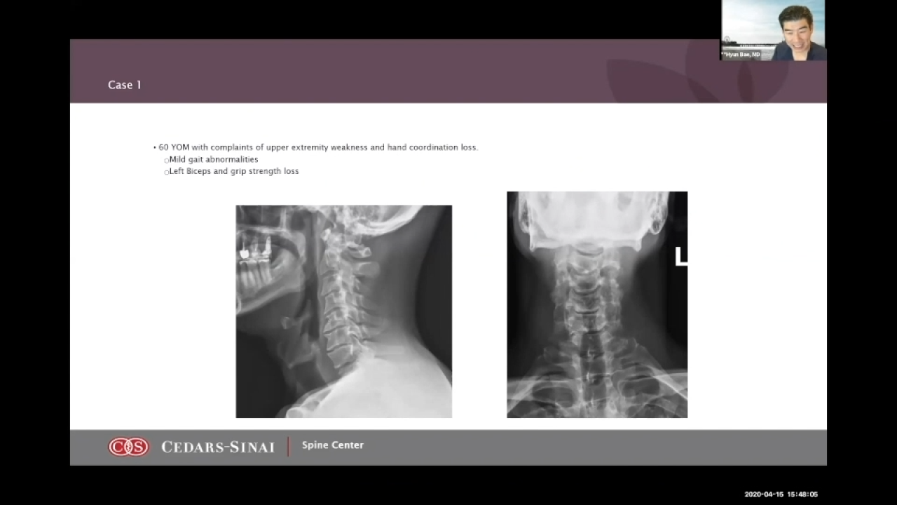 thumbnail image of Role of Biomaterials in Revision Spine Surgery with Hyun Bae, MD & Frank LaMarca, MD