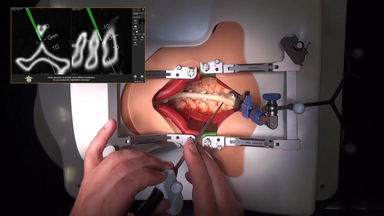 This is an image from the "Navigated Instrumentation in the Posterior Cervical Spine with Prof. Claudius Thome" playlist on the JnJInstitute.com website.