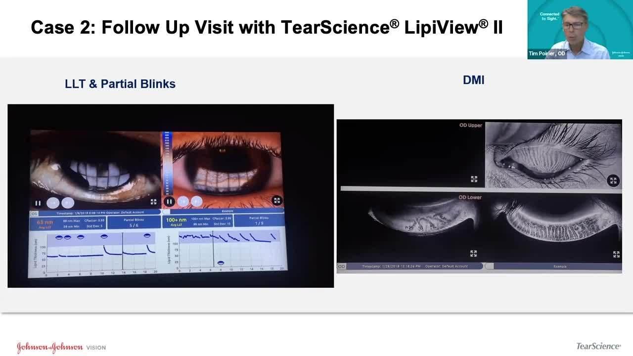 An image from the "MGD in the Contact Lens Patient - A Case of Patient Experiencing Discomfort Wearing Contact Lenses with Dr. Timothy Poirier" video on the JnJInstitute.com website.