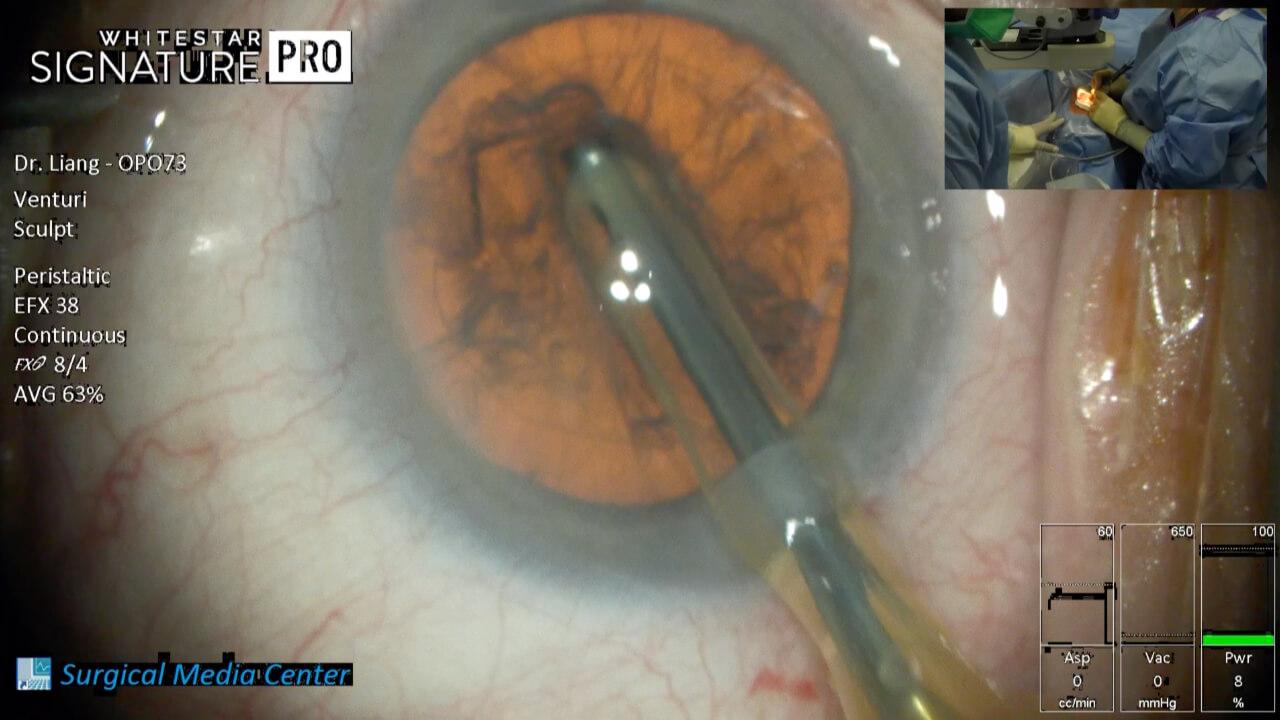 An image from the "Phacoemulsification Process from Start to Finish with Dr. Eva Liang" video on the JnJInstitute.com website.