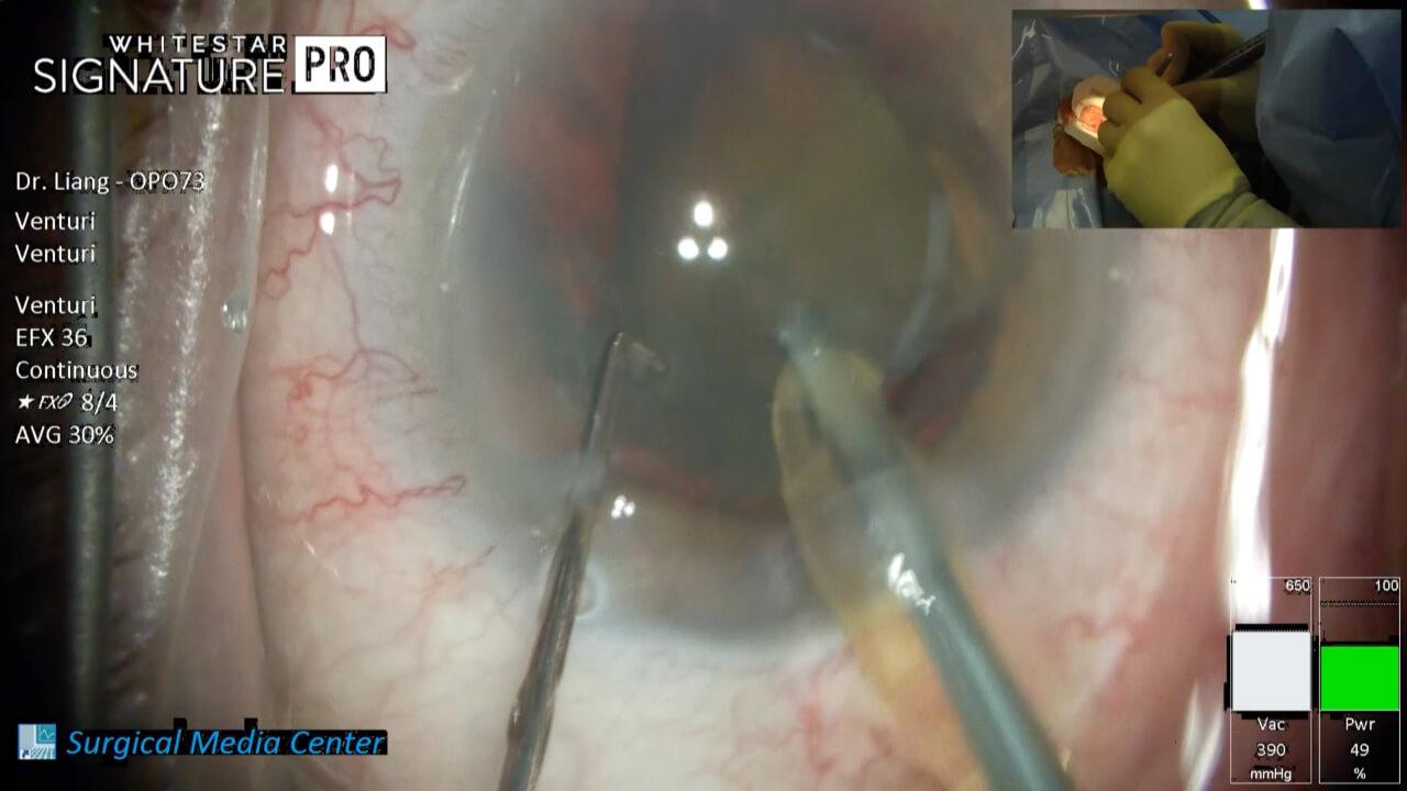An image from the "Eye Wash to Suture on Phacoemulsification Procedure with Dr. Eva Liang" video on the JnJInstituet.com website.