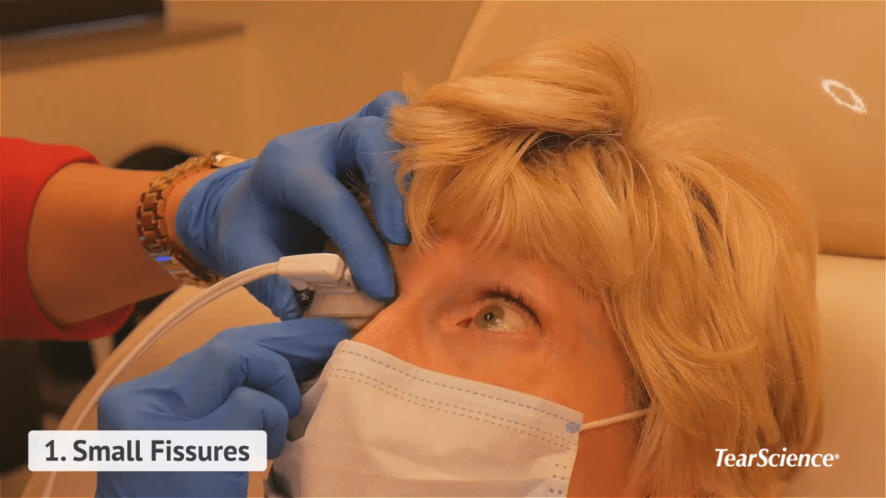An image from the "OSD Patient Journey: Video 8 - TearScience® Activator Placement Tips with Dr. Whitney Hauser" video on the JnJInstitute.com website.