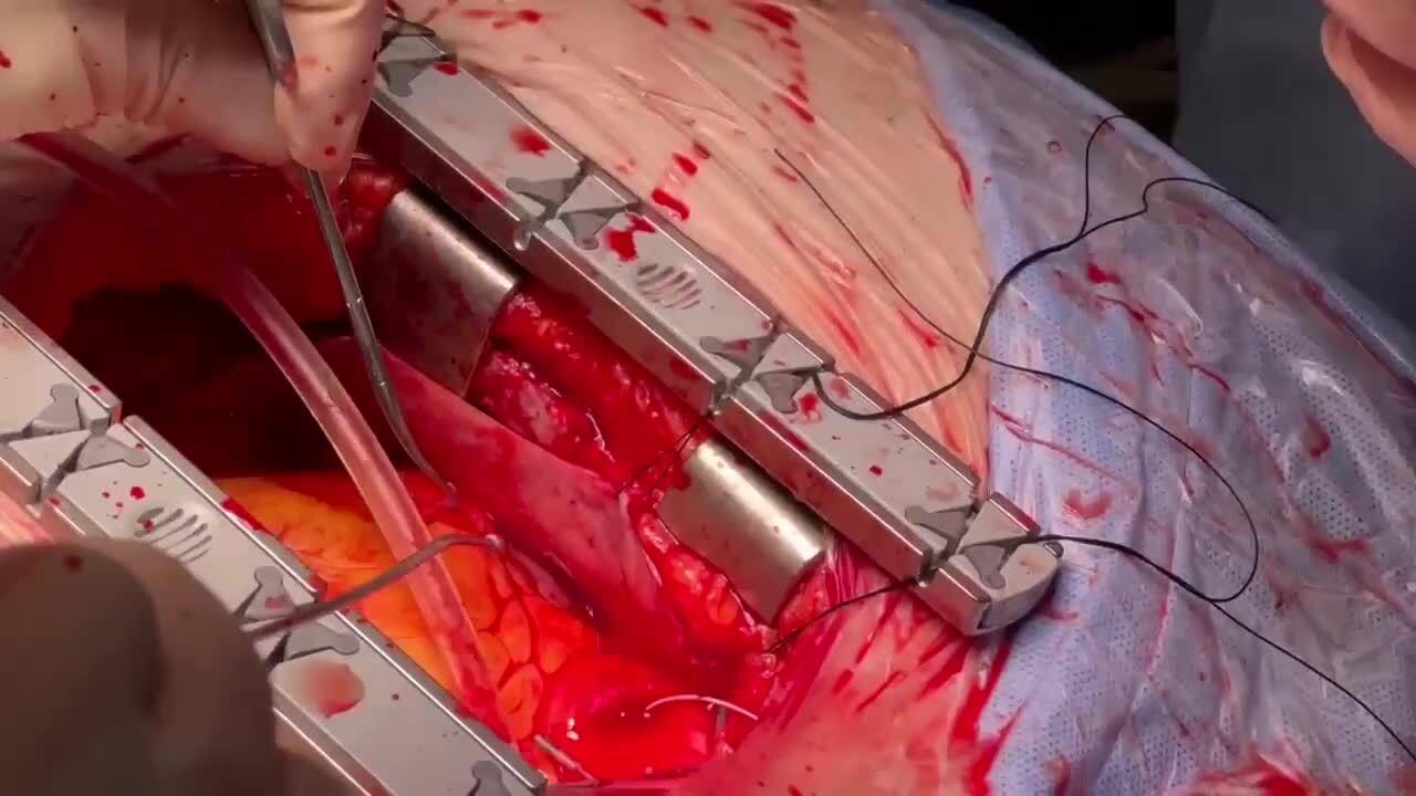 Coronary Artery Bypass Grafting (CABG) - Proximal Anastomosis (single clamp technique) 3/4