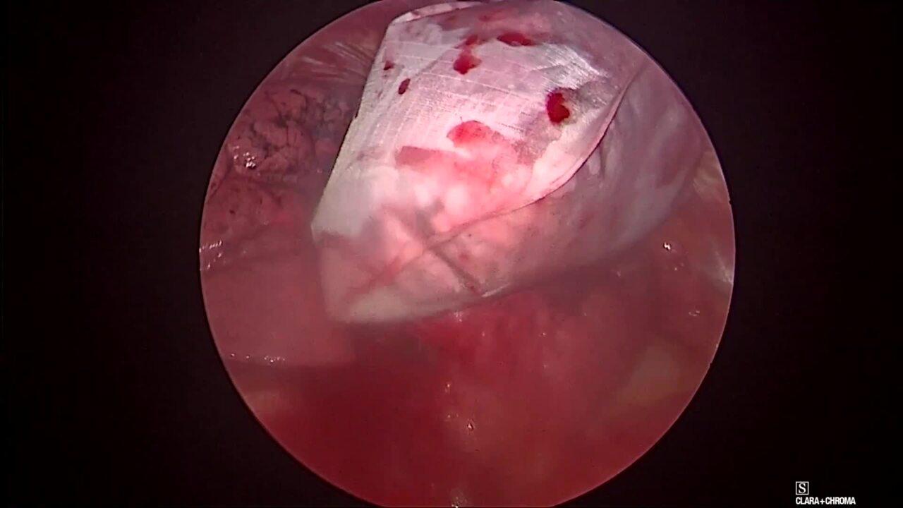 Thorascopic Lobectomy - Remove the Specimen