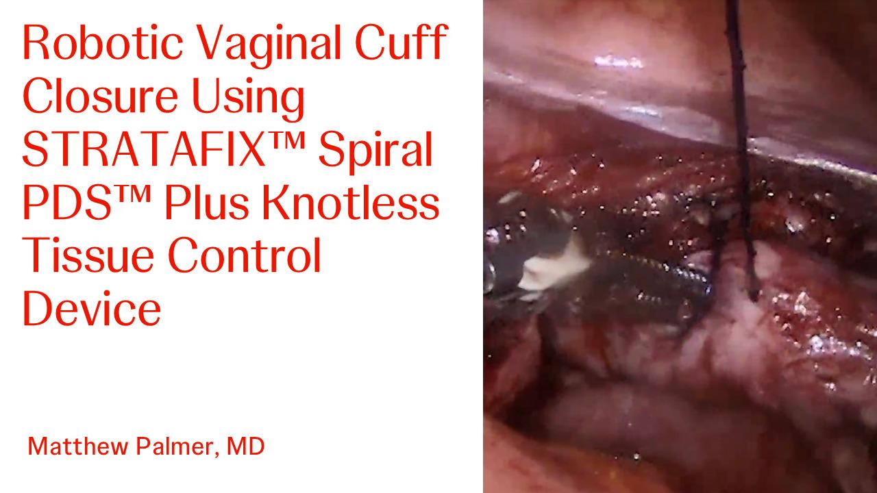 STRATAFIX™ Spiral PDS™ Plus Knotless Tissue Control Device in a Robotic Vaginal Cuff Closure with Matthew Palmer, MD