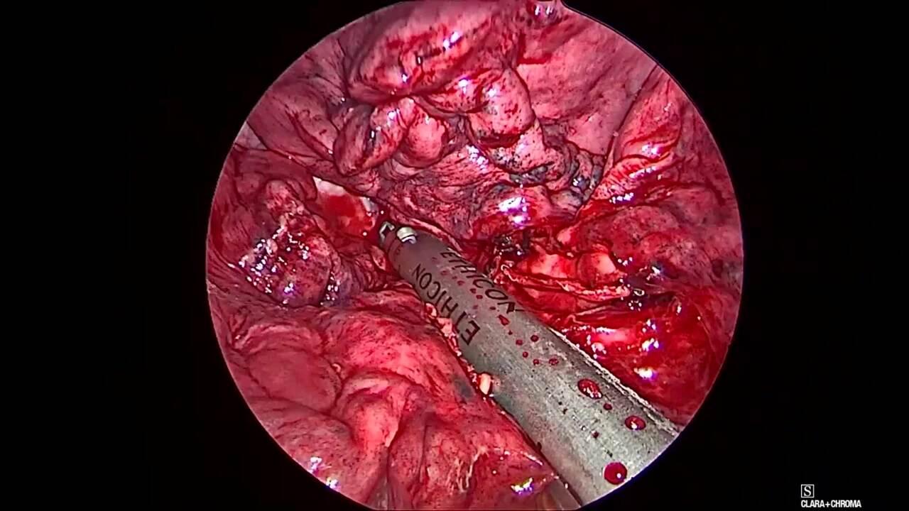 Thorascopic Lobectomy - Staple and Divide the Lobar Bronchus