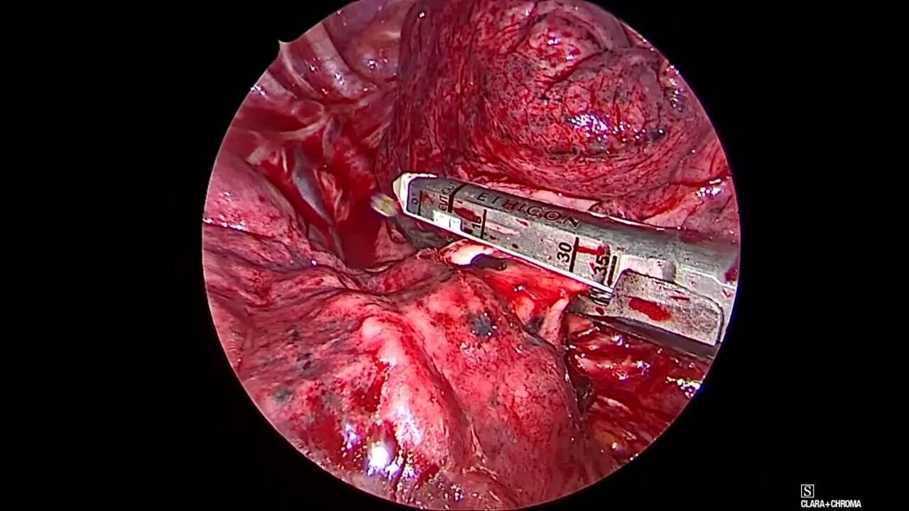 Thorascopic Lobectomy - Staple and Divide the Pulmonary Artery