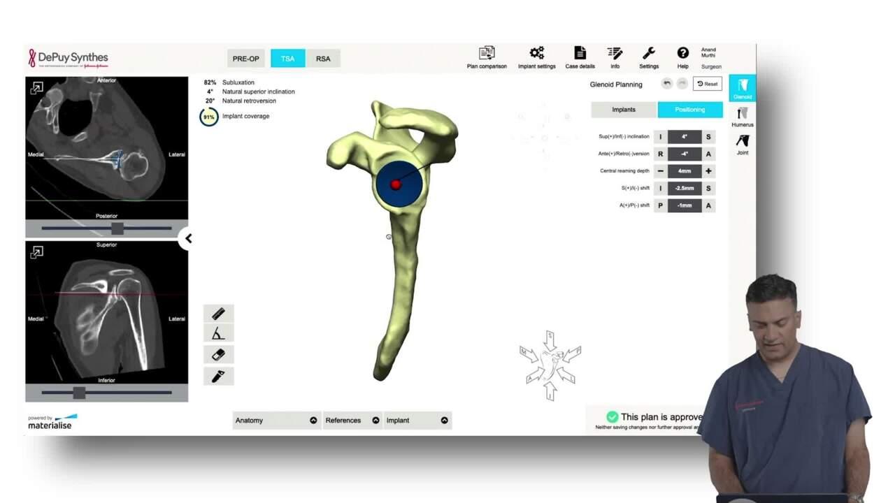 TRUMATCH Software Review: Anatomic Total Shoulder - Anand Murthi, MD thumbnail