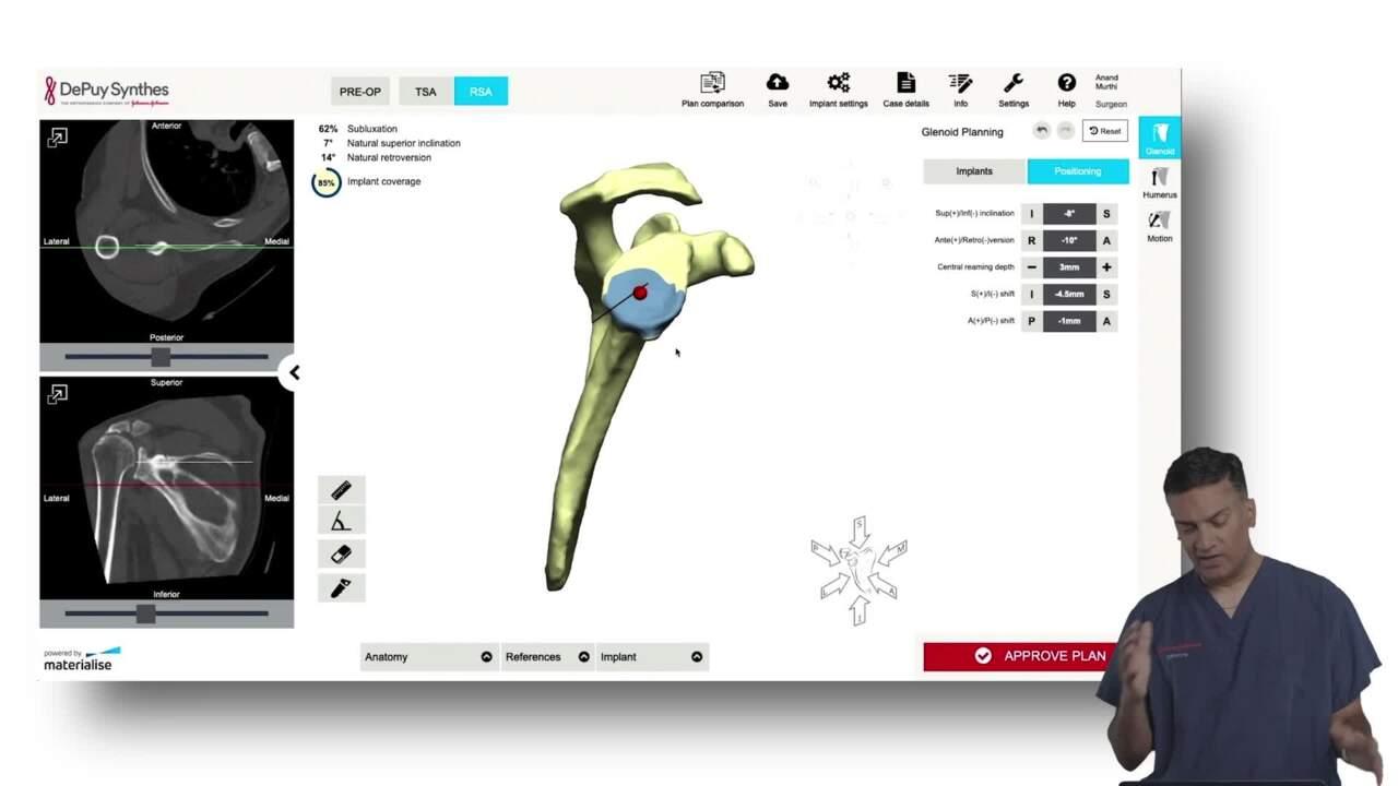 TRUMATCH Software Review: Reverse Total Shoulder - Anand Murthi, MD thumbnail