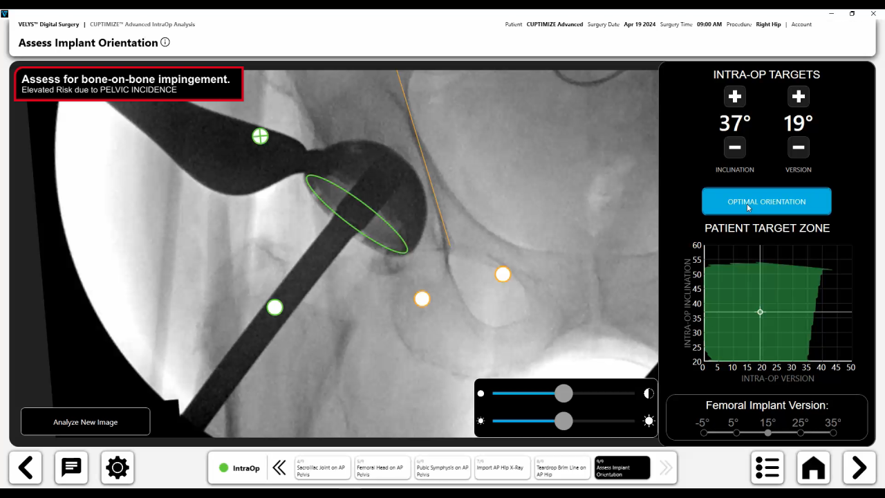 Image from CUPTIMIZE™ Advanced Hip-Spine Analysis & Guidance: Cup Check Workflow Demo