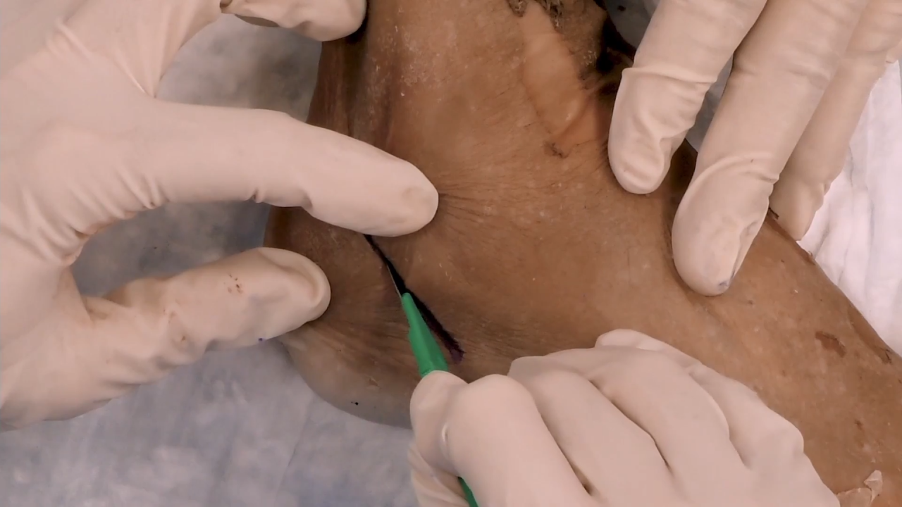 Image from Posterior Calcaneal Slide Osteotomy with Sean Grambart, DPM