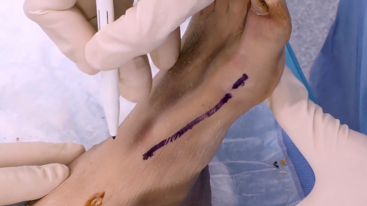 Image from Lapidus Arthrodesis Using 90/90 Continuous Compression Implants with Sean Grambart, DPM