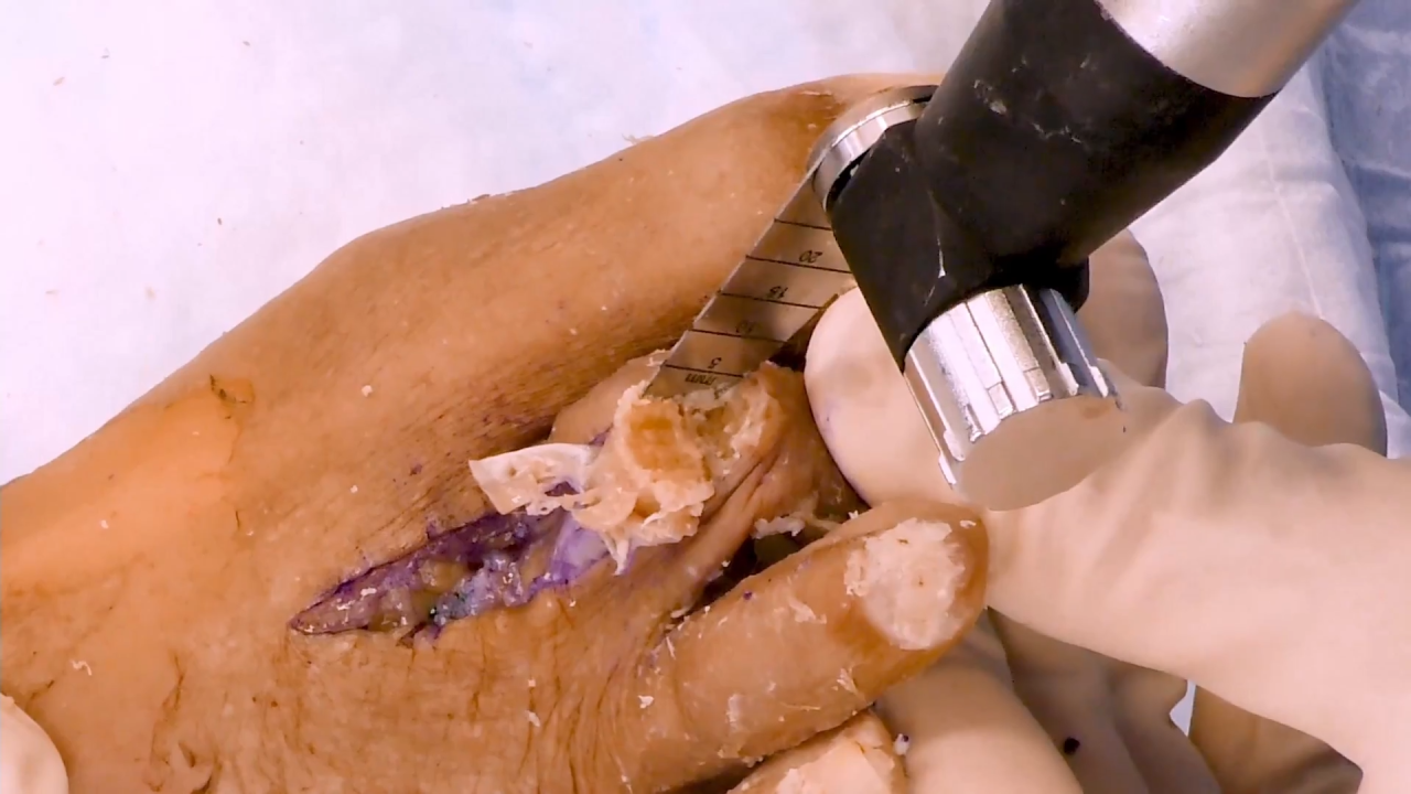 Image from Hammertoe Correction Using Screw Fixation with Sean Grambart, DPM